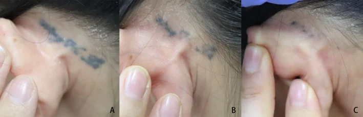 Published tattoo-removal case: before, after one and after two treatments